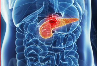 健康热帖:身体突发4种不适 或是胰腺癌早期信号