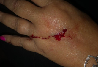 士嘉堡道路施工致鼠患严重 女子自家后院被咬伤