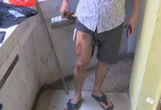 可怕！苹果手机放裤袋自燃 男子被严重烫伤