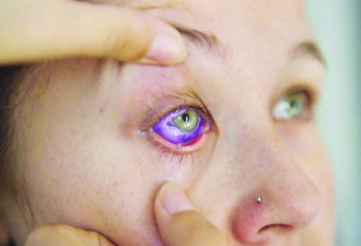 安省即将立法禁止眼球紋身