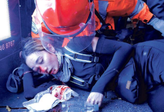 香港示威者被射爆眼 警察遭汽油弹烧伤