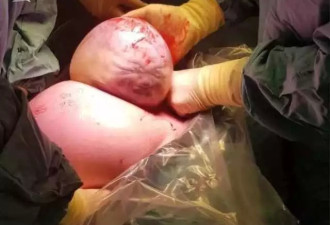 女子剖腹产子 男婴刚取出似外星人！医生：天呐