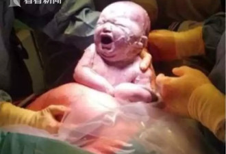 女子剖腹产子 男婴刚取出似外星人！医生：天呐