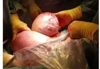 女子剖腹产子 男婴刚取出似外星人！医生：天呐