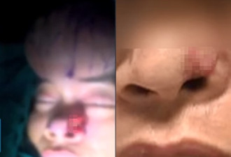 同学聚会喝醉发酒疯　深圳男被咬掉鼻子