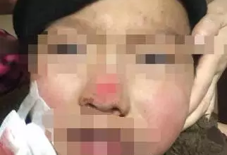 男童鼻头被削掉 母亲捡起就往医院跑