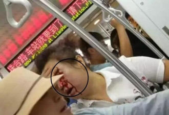 地铁上，大妈“嘴贱”被孕妇砸伤，血流满面
