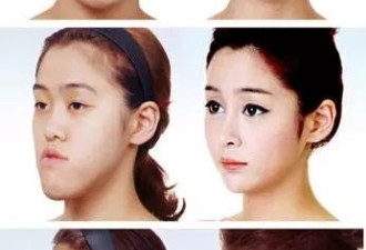 泰国女孩整容变女神 换头整容术震惊全亚洲！