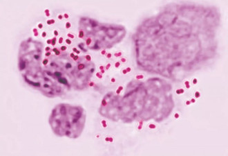 阿尔伯塔梅毒爆发：全国性病传染率上升