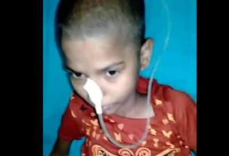 14岁印度女孩因胃痛被送往医院 胃里有巨大毛球