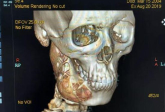 15岁男孩牙疼一年多 脸部骨头被“吃”一半