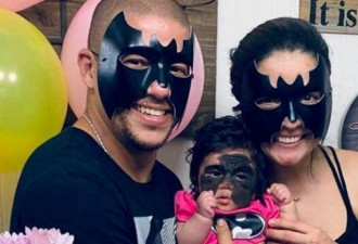 美女婴患罕见皮肤病 面部天生有蝙蝠侠面具