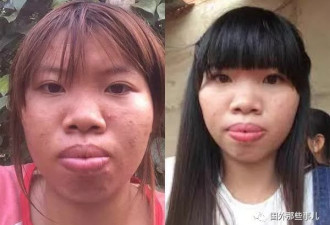 丑姑娘花整容后嫁给富二代 离婚如今又有恋情