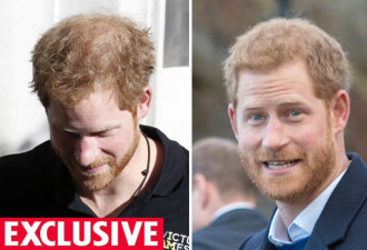英王室最后一个发际线坚挺的哈里 也要去植发了