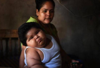墨西哥10个月大男婴重56斤，医生们束手无策