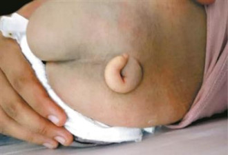 新生儿出生带长尾巴 因妈妈怀孕前期未吃它