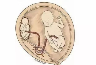 双胞胎姐妹在妈妈肚子里抢血 所幸医生当机立断