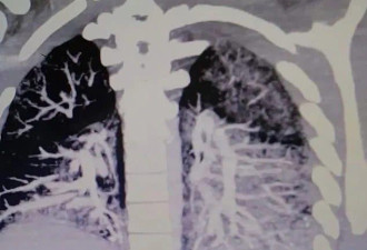 美国少年抽2年电子烟，X光下肺里全是这种东西