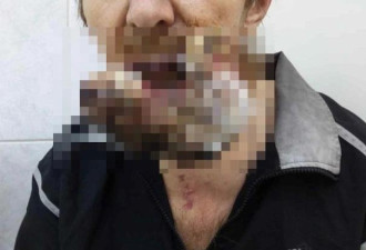 俄罗斯男子嘴巴长肿瘤拒绝治疗，肿瘤深入头骨
