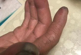 慎入：除夕夜，环卫工的手被垃圾腐蚀成这样