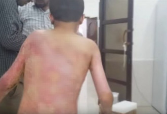 土耳其打库德族疑用化武 叙利亚孩童遭白磷灼伤