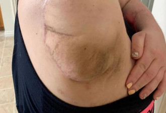 忽视了这些警告信号！女子右臂失去一条胳膊