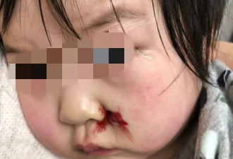 多伦多华人2岁女孩脸上扎了血窟窿 学校竟然…