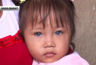 印尼小女孩患罕见病眼球天生能变4种颜色