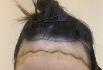 90 后美女被剃成秃子后才被告知不能植发