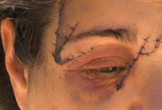 女子被受惊袋鼠疯狂攻击，脸部缝25针