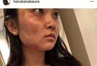 新西兰中国女留学生惨遭男友家暴！还用车拖拽