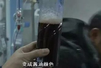 严重或致命！吃了这菜 男童排出酱油尿