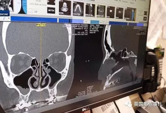 狂流鼻涕5年，最近她才发现这鼻涕竟是脑液...
