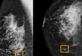 误诊率比医生低：人工智能可准确检测出乳腺癌