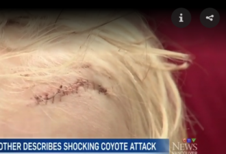 3岁男童遭土狼袭击 血流满面缝了150多针
