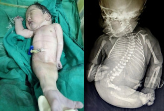 婴儿双脚相连如美人鱼 出生15分钟就夭折