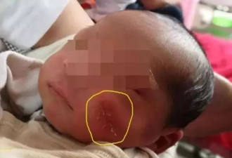 刚出生婴儿脸上被缝8针，竟是医生手术刀割的