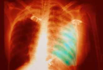 最新通报：武汉肺炎患者增至198人 死亡3例