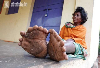 印度女子12根手指19根脚趾 破世界纪录