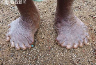 印度女子12根手指19根脚趾 破世界纪录