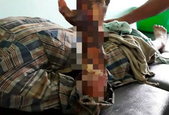 7岁男孩太淘气，被父亲虐待烧伤，失去手臂