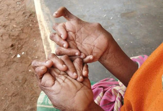 慎入：印度女子12根手指19根脚趾 破世界纪录