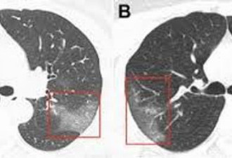 中国公开感染冠状病毒患者的肺部图片