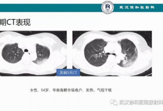 美院士：用CT作为新型肺炎确诊标准刻不容缓