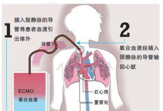 重症肺炎最后都要用人工肺吗？用一次多少钱