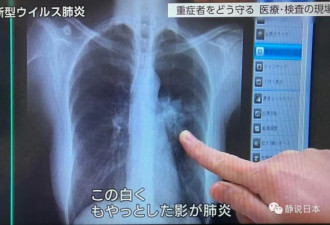 日本新冠病毒医生：如何区分新冠与一般感冒？