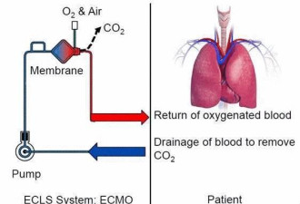 他竟然让新冠危重患者带着ECMO踩自行车