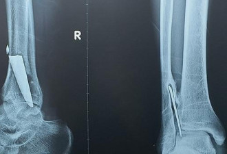 男子右腿疼痛3年,跑去照X光发现10厘米的刀