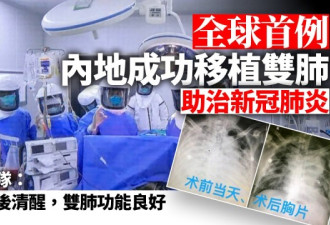 中国创全球首例！新冠肺炎病人成功移植双肺