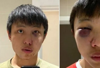 因新冠遭歧视,新加坡留学生在伦敦街头惨遭围殴